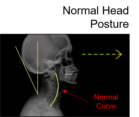 fhp-posture-compare-image-normal
